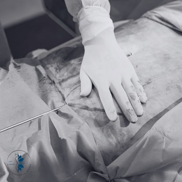 ابدومینوپلاستی و لیپوساکشن